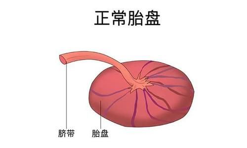 帆状胎盘是什么？